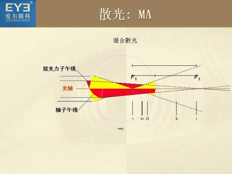 散光主要是指由于眼球各子午线屈光力不一样,光线经过眼的屈光系统后