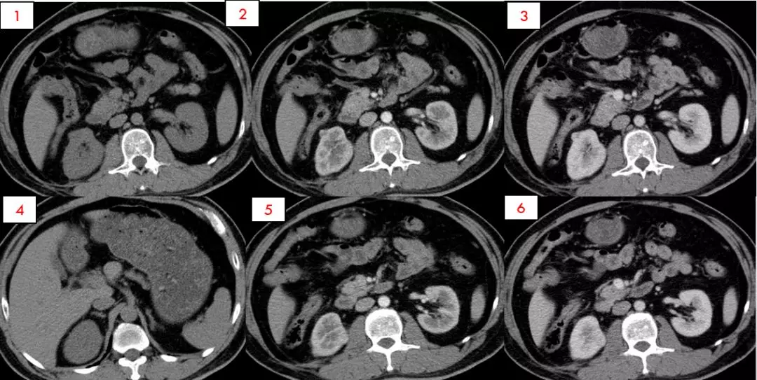 肾癌进展—肾细胞癌的ct和mri诊断及鉴别诊断要点