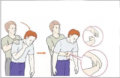 注意: 对1岁以下的婴幼儿不可施行海姆立克急救法,以免伤及腹腔内