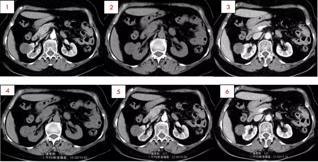 肾癌进展—肾细胞癌的ct和mri诊断及鉴别诊断要点