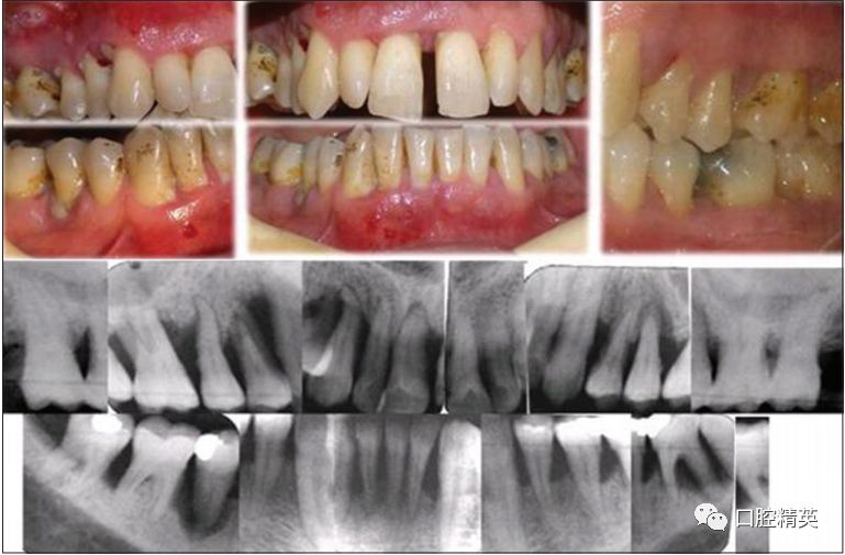 一例重度牙周炎治疗_牙周病