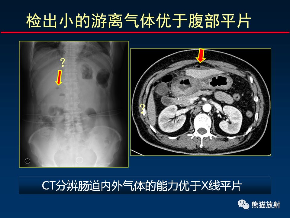 柳澄讲坛丨正确认识ct在胃肠道疾病中的价值