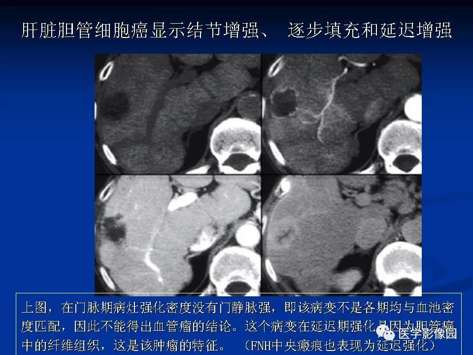 肝脏血管瘤影像学表现及鉴别诊断二影像天地