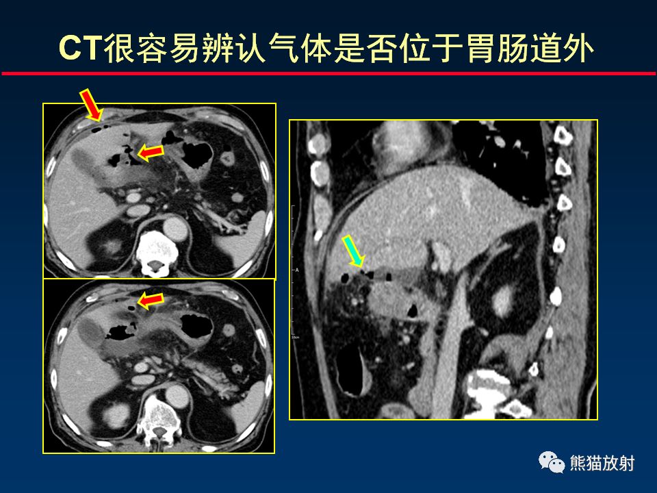 柳澄讲坛丨正确认识ct在胃肠道疾病中的价值