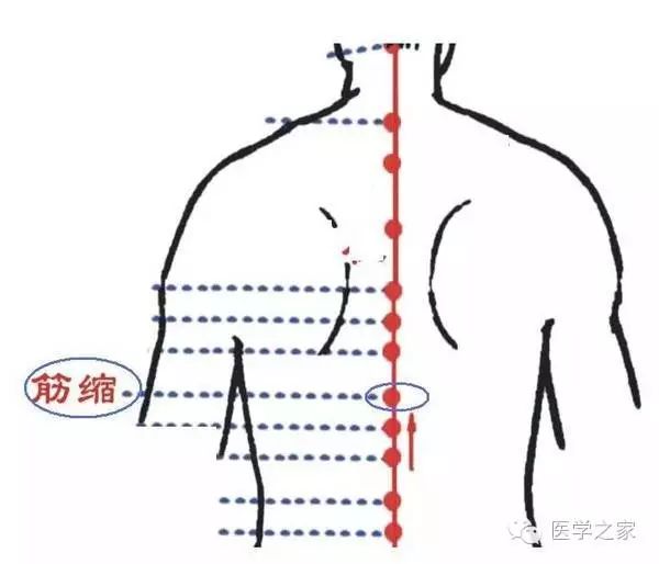 49,腰椎盘突出穴——筋缩