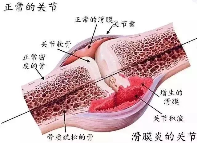 膝关节肿胀疼痛怎么办