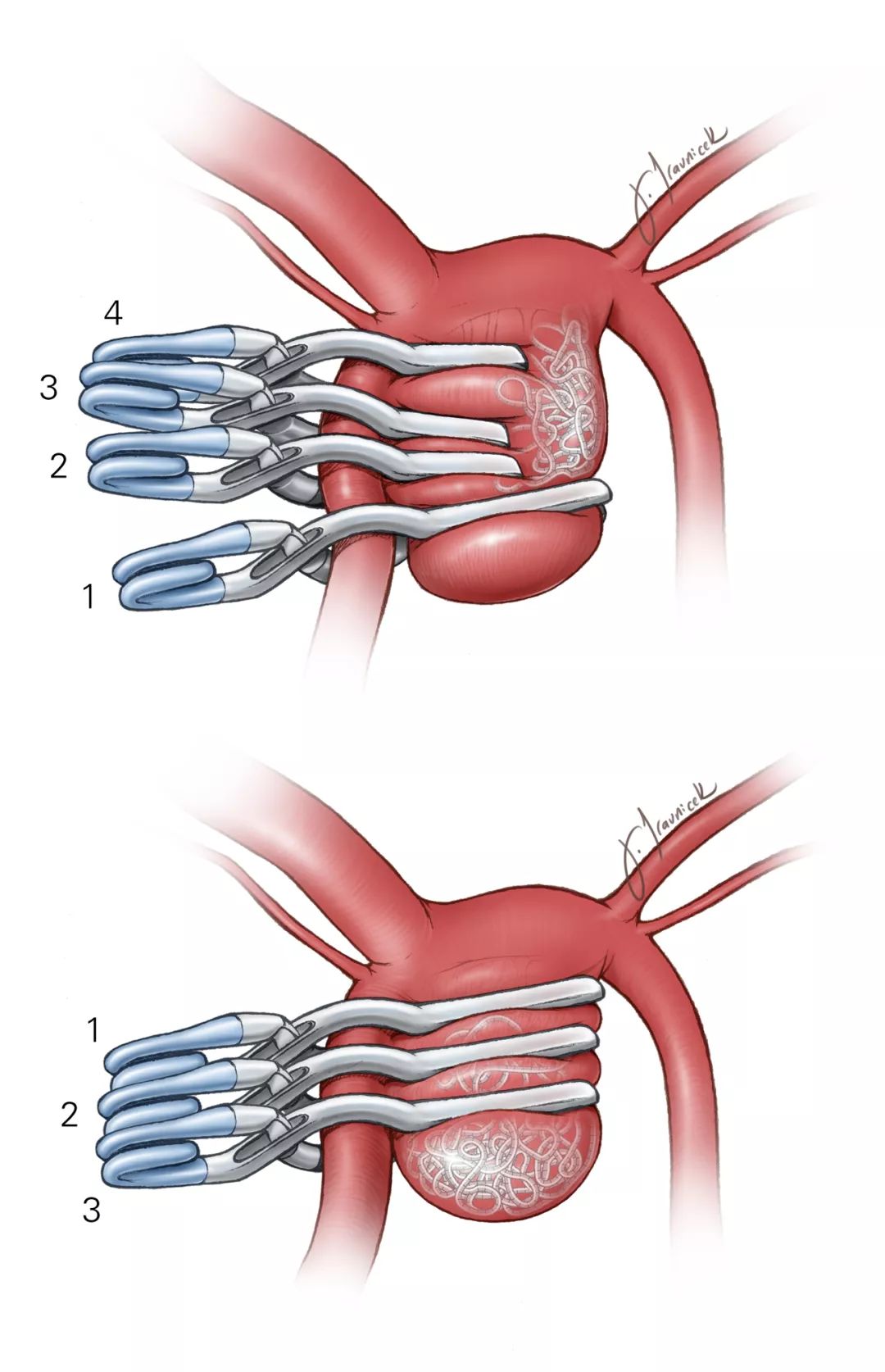 栓塞失败动脉瘤夹闭的手术策略与技巧 | the neurosurgical atlas全文