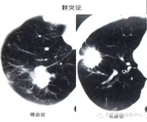 密集排列就构成锯齿征,棘状突起粗细,长短不一时,如螃蟹足,就是伪足征