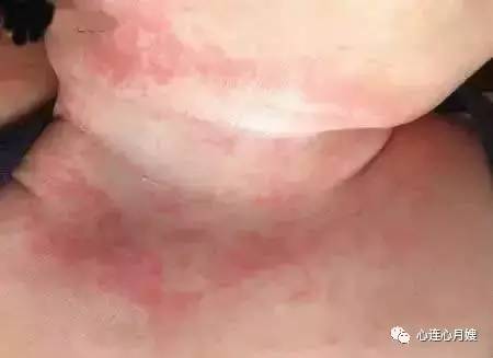 宝宝湿疹图片怎么办