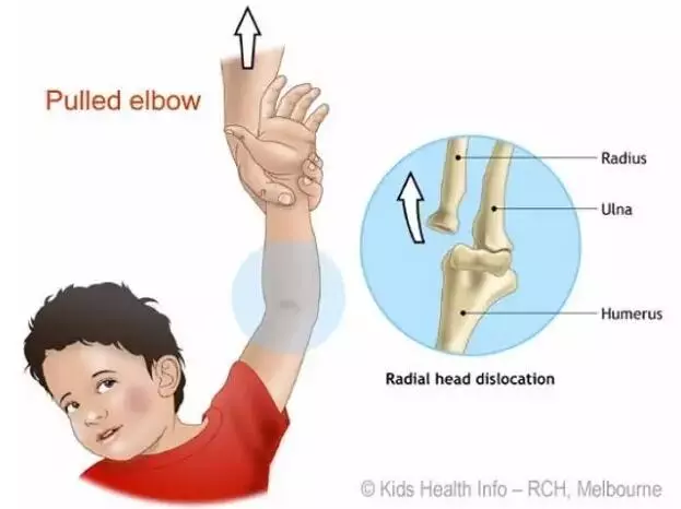 通过问诊及观察, 骨科医生确诊果果为"左肘关节桡骨小头半脱位"
