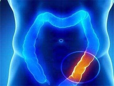 大肠癌：两种典型症状表现！