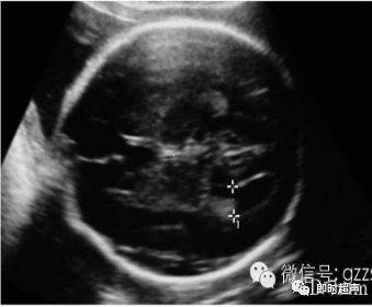 产前超声之最纠结:胎儿侧脑室临界性增宽