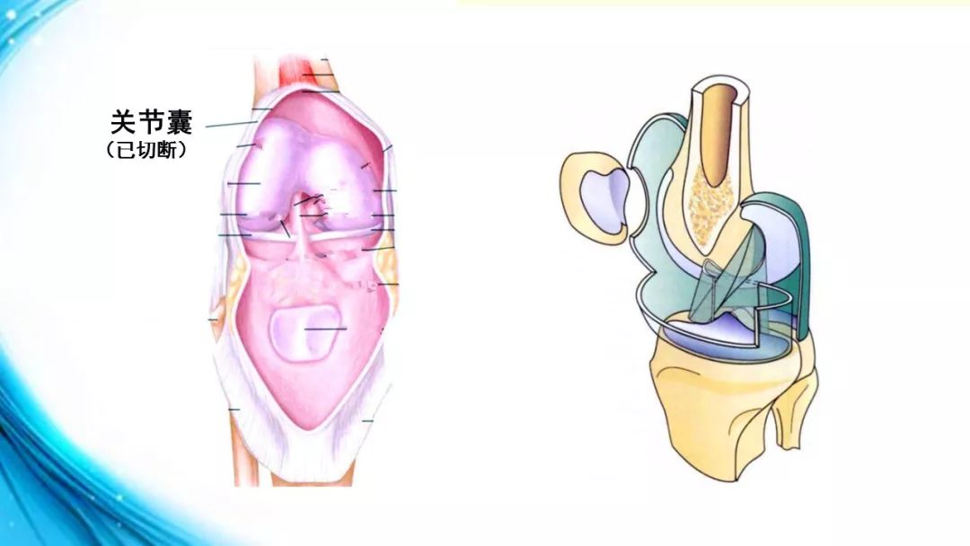 液体积聚在髌上囊,髌旁凹陷,以及股骨滑车深面的黏液囊后面,在膝关节