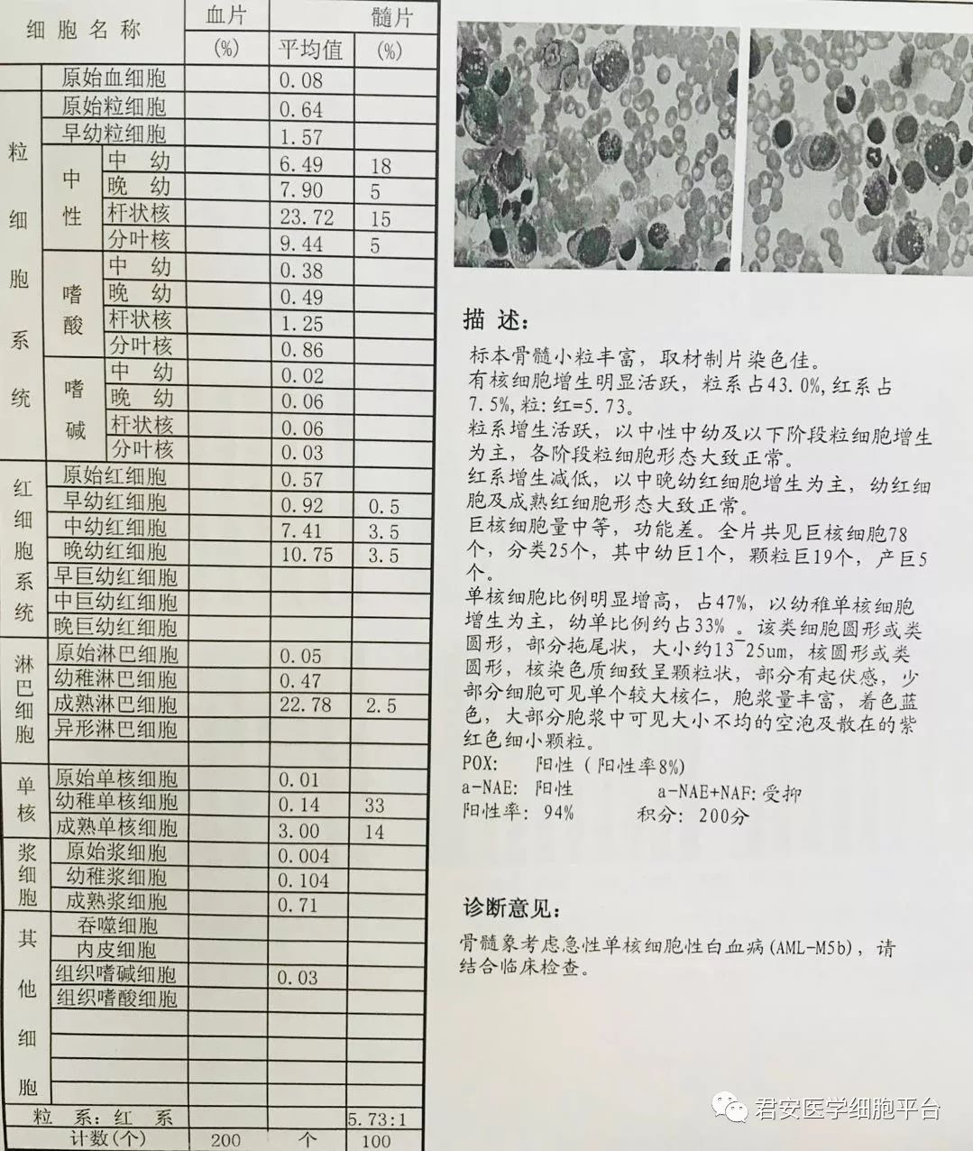 骨髓报告 (注:阳性率94%,积分200是指nap)