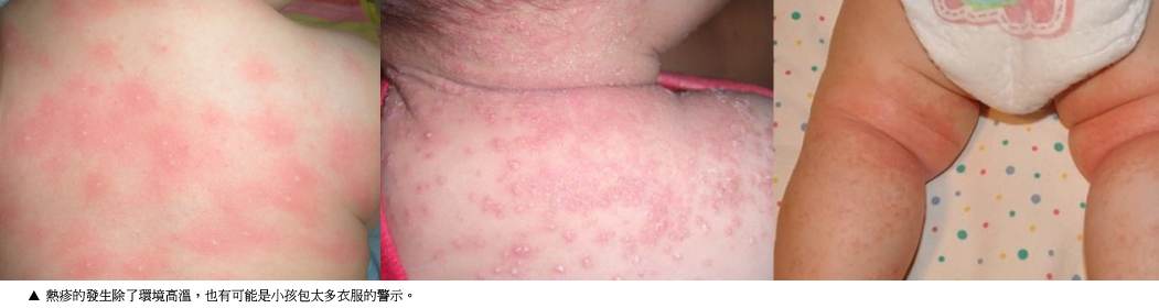 新生儿常见的疹子辨别与照护