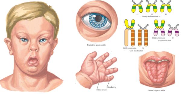 唐氏病人口_唐氏综合症病人图片