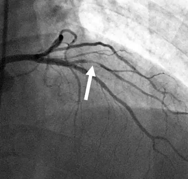 x光透视下的冠状动脉箭头示病变狭窄的血管