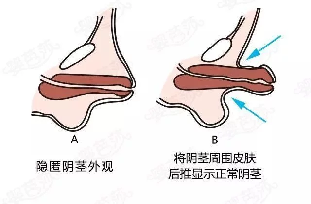 隐匿阴茎区别于包皮过长,是一种常见的先天发育异常和畸形性疾病