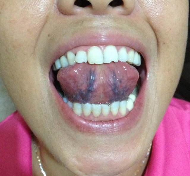 其实每个人的舌头下都会有呈蓝色的血管,这是浅表的舌下静脉丛,舌下