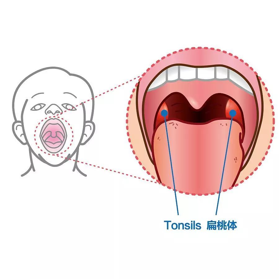 小南话科普你的扁桃体究竟需不需要割