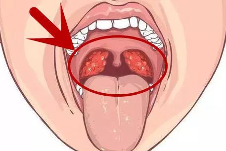 就是上面红圈圈里的两个红红哒东西 注:  扁桃体位于口咽部两侧,是