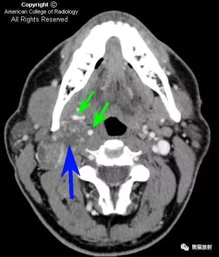 双语病例丨颈部迷走神经鞘瘤vagalschwannoma