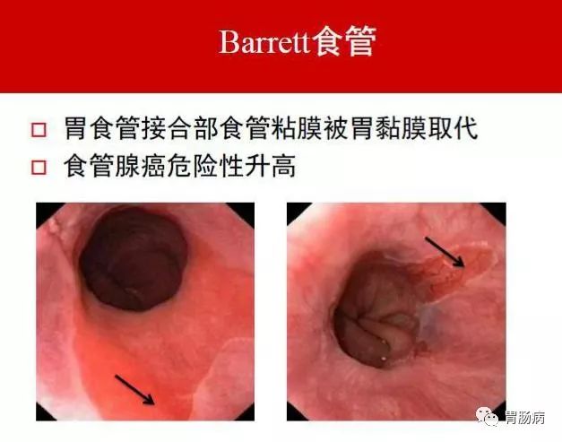 如果barrett食管伴有不典型增生,长期没有治疗可能增加癌变的机会.