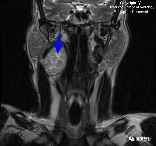 双语病例丨颈部迷走神经鞘瘤 vagal schwannoma