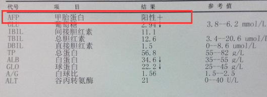 甲胎蛋白(afp)的检测正常情况是阴性,正常值就是0—25μg/l,若超过25