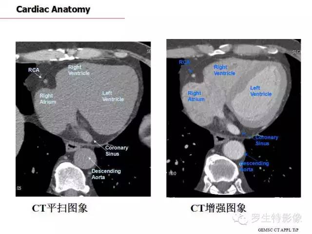 心脏ct断面解剖