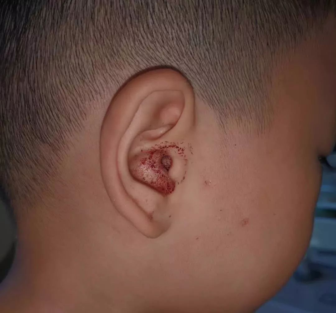 孩子用棉签挖耳朵戳穿耳鼓膜,还惹来超强细菌!医生:这些做法要不得!
