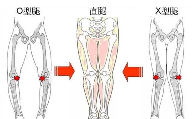 o型腿,x型腿