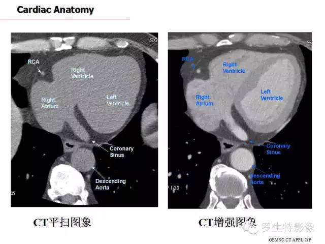 心脏ct断面解剖