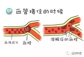 静脉溶栓是脑梗死最有效的治疗方法