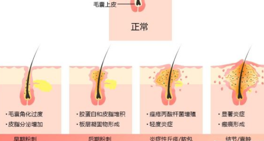 平时毛囊开口畅通,它就各种装老实,一旦毛囊形成封闭环境,可就不