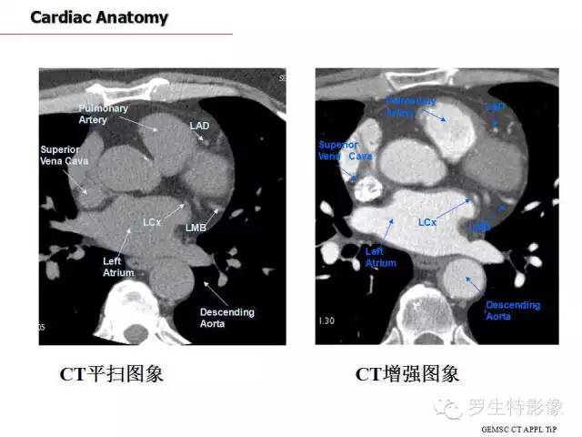 心脏ct断面解剖