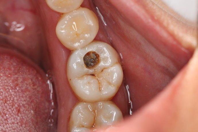 比如吉兰抗过敏牙膏等等,尤其是牙髓边缘,牙髓露出还能安抚治疗