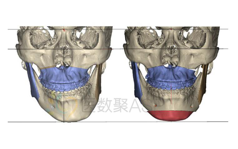 数字化正颌外科治疗——偏颌畸形案例