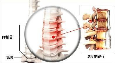 强直性脊柱炎如何引起？怎样预防强直性脊柱炎？