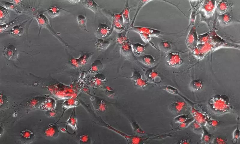 显微镜下捕获的自残的脑肿瘤细胞.红色是细胞"自噬"过程的标记物.
