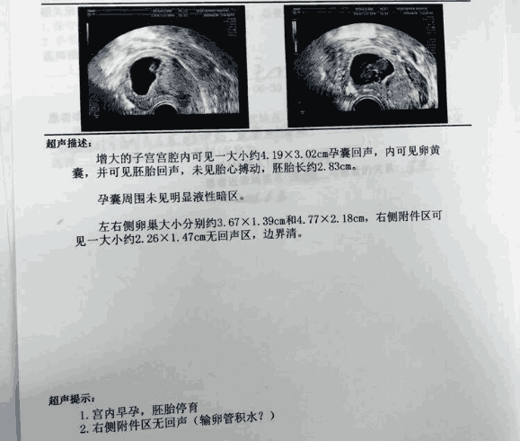 孕妈的4种特征表现,为产下唐氏儿埋下伏笔,尤其最后一