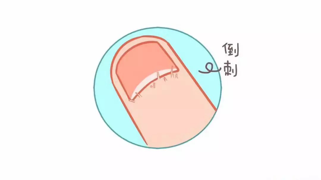 手撕倒刺差点截肢白点凹陷倒刺宝宝指甲问题全解析