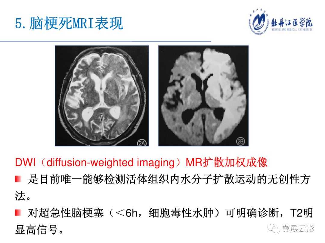 脑梗死影像诊断