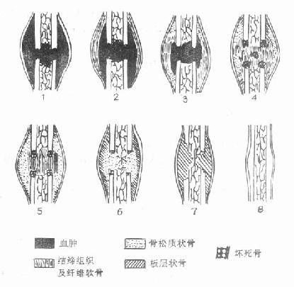 骨折半年后疼痛怎么办