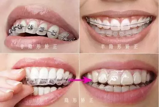 钢丝矫正, 就是在矫正牙齿的过程中用一种专用的粘接剂固定在牙齿
