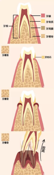 牙周问题的群象 因为没有做到这一项也会导致脱落?