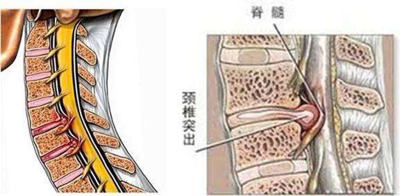 脊髓型颈椎病早发现,警惕颈椎常见的3个症状