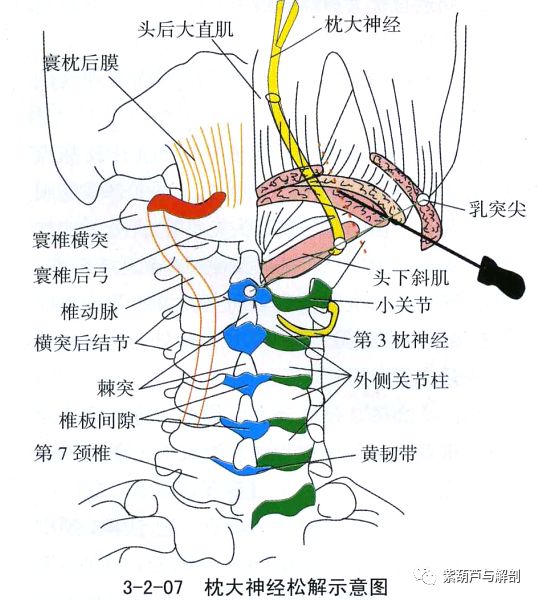 枕大神经卡压 | 第2颈神经后支卡压综合症