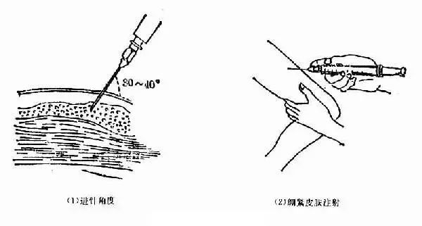 皮下注射什么时候垂直进针,什么时候斜刺进针?进来看看