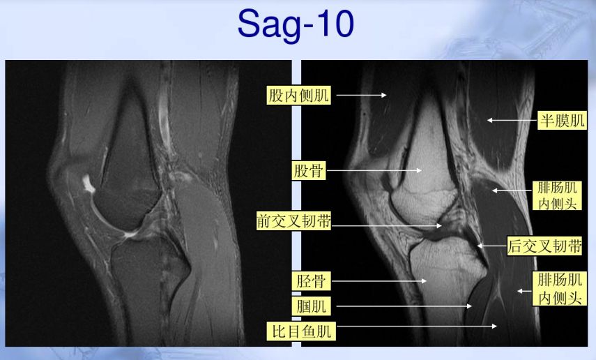 解剖膝关节(图文)二